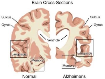 alzheimer-le-donne-corrono-piu-rischi-di-sviluppare-questa-malattia Alzheimer: le donne corrono più rischi di sviluppare la malattia