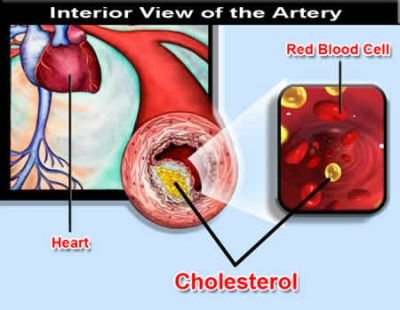Un terzo tipo di colesterolo espone a rischio infarto la lipoproteina A